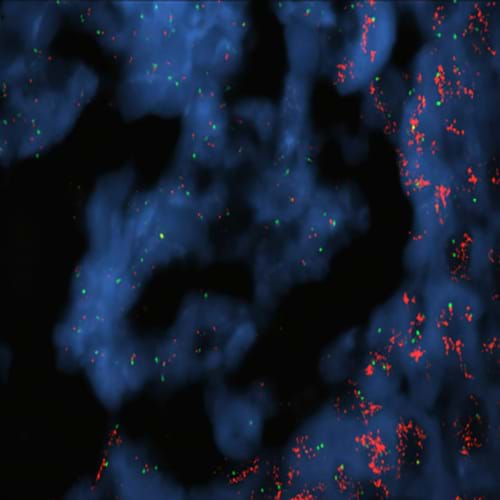 Eksempel på Her2 FISH til diagnostisering av brystkreft.