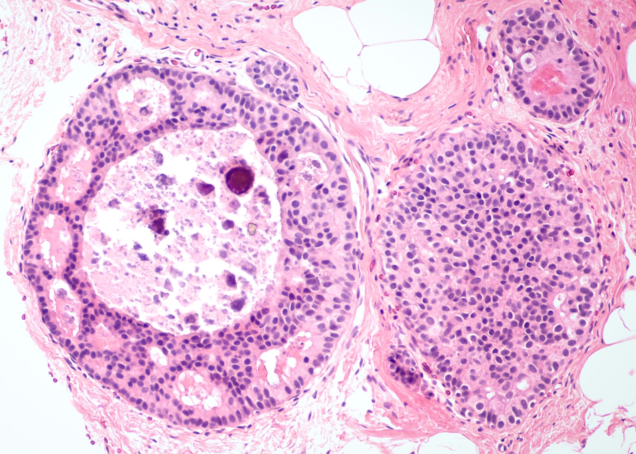 Mikroskopibilde av brystkreftceller, farget med hematoksylin og eosin (HE). Bildet viser unormalt delende celler med tettpakkede kjerner og varierende celleformer, karakteristisk for kreftvev.