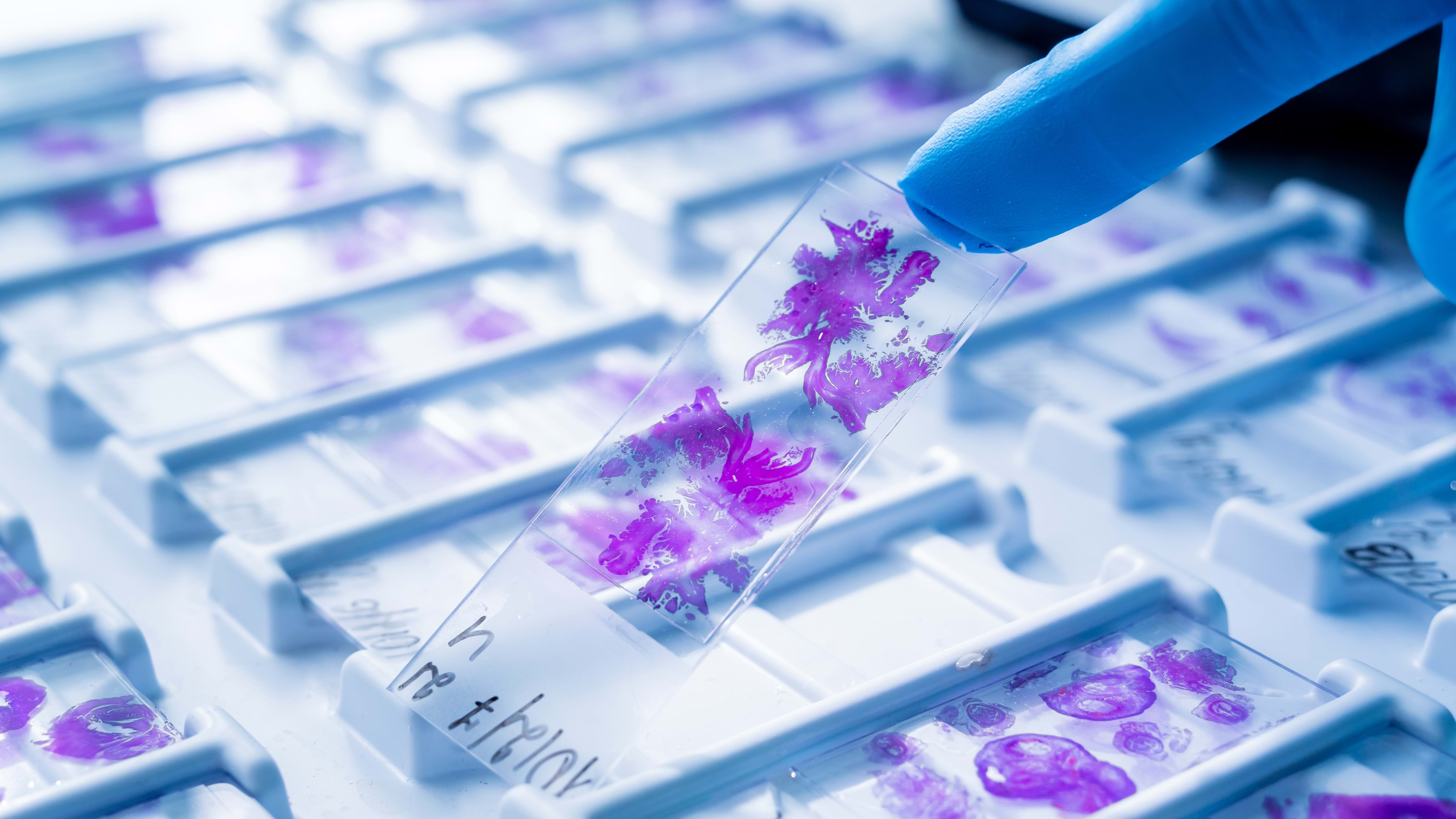 Fra pasientprøve til diagnose  – patologilaboratoriets viktige rolle